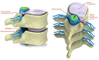 visuel 3D d'une hernie discale